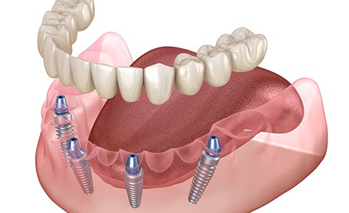 Implant dentures combine the durability of dental implants with the convenience of dentures