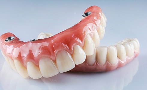 If you are in good oral health and have sufficient jawbone density you may be a good candidate for implant dentures