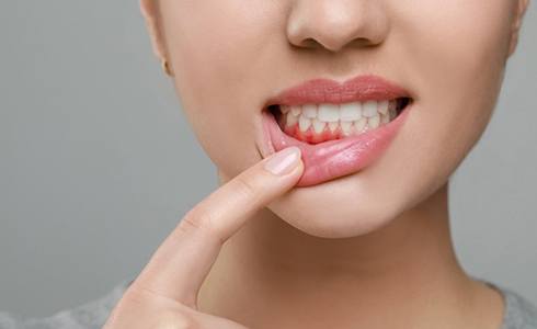 a woman showing signs of gum disease
