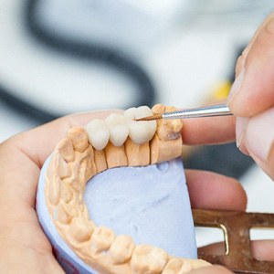 dentist perfecting dental bridge